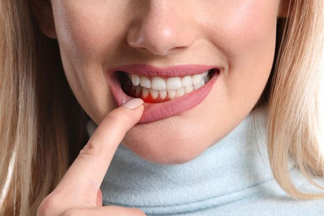 Woman pointing to her gums showing signs of inflammation, highlighting the importance of periodontal maintenance for oral health after gum disease treatment.
