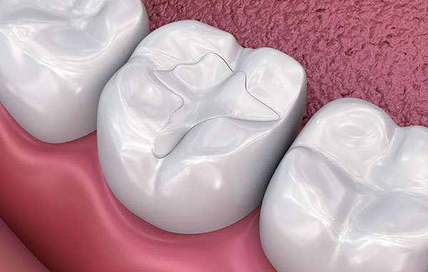 dental fillings; tooth-colored fillings