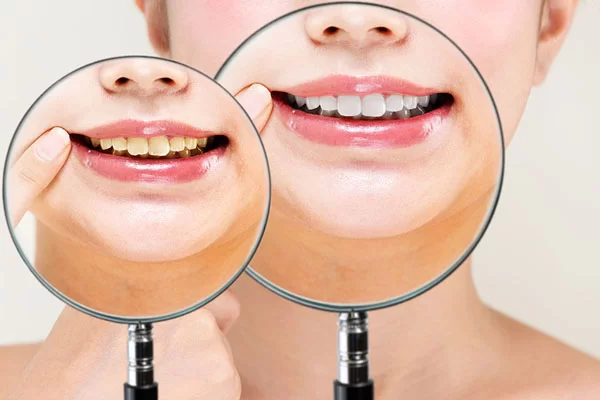 before and after teeth whitening treatment