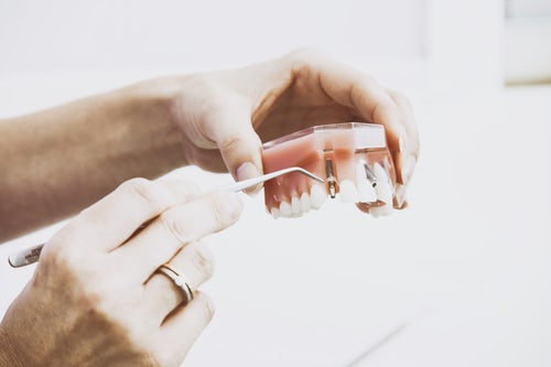 a dental implant in pearl